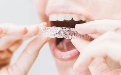 closeup of woman's mouth putting on a transparent retainer with soft natural lighting